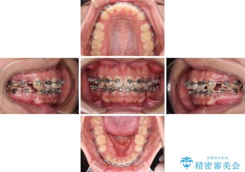 気がつくと唇が開く 口元を下げる抜歯矯正の治療中