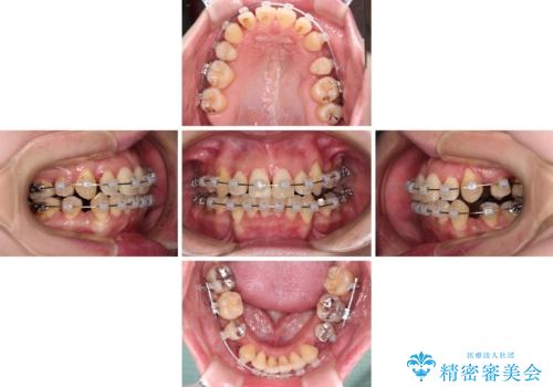 【モニター】上下の八重歯を治したい ワイヤー装置による矯正治療の治療中