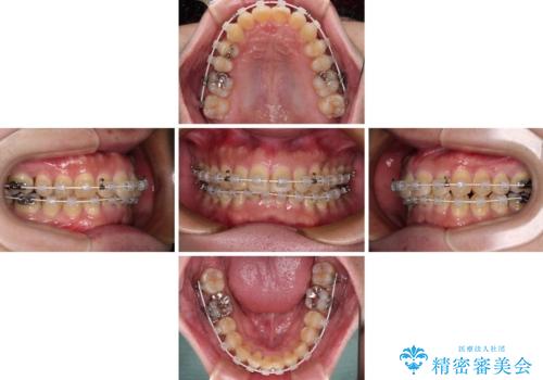 深い咬み合わせで顎が疲れる ワイヤー矯正でディープバイトを解消の治療中