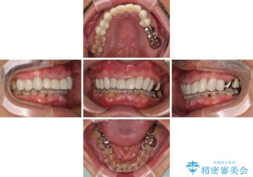 変色した前歯をきれいにしたい　部分矯正を併用した前歯の審美歯科治療の治療中