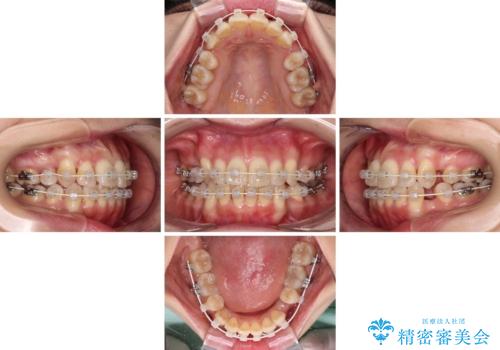 デコボコで磨きにくい歯列 ワイヤー装置での抜歯矯正で歯磨きをしやすくの治療中
