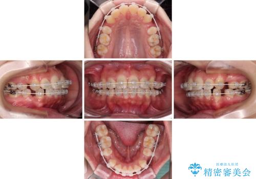 くちばしのような前歯が気になる ワイヤー装置による抜歯矯正治療の治療中
