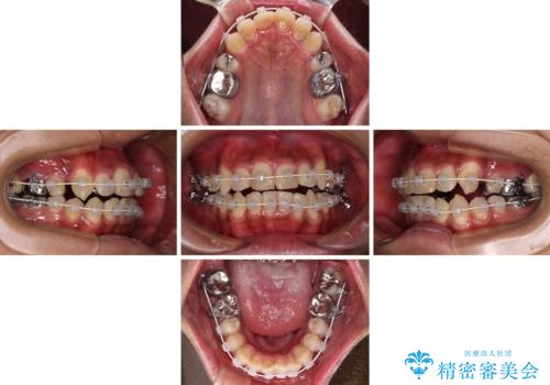 八重歯と開咬 ワイヤー装置での抜歯矯正の治療中