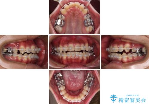 八重歯と開咬　ワイヤー装置での抜歯矯正の治療中