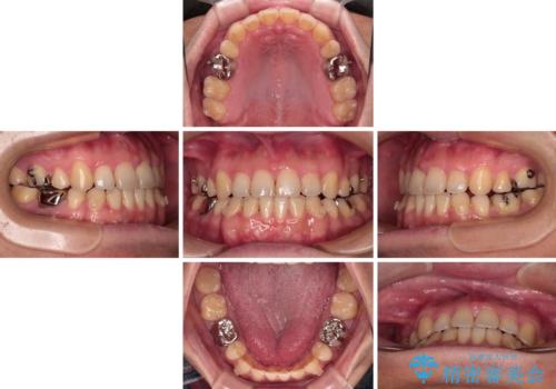 【モニター】舌のトレーニングを行いながら後戻りの再矯正の治療中