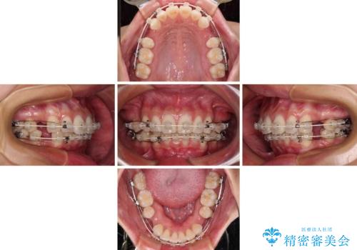 尖った前歯を引っ込めたい 目立たないワイヤー装置での抜歯矯正の治療中