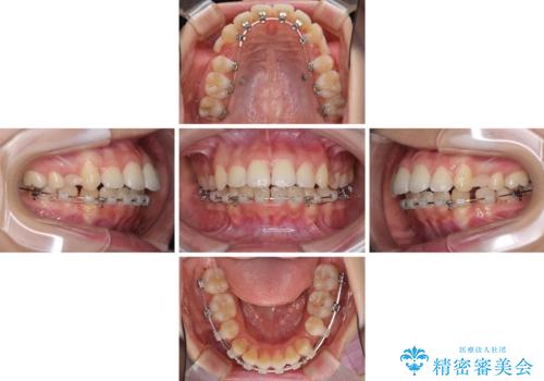 目立たない裏側装置 ハーフリンガルの抜歯矯正の治療中