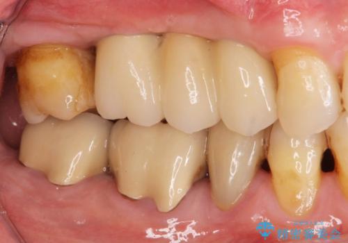 失った奥歯を、インプラント治療で機能回復の治療後