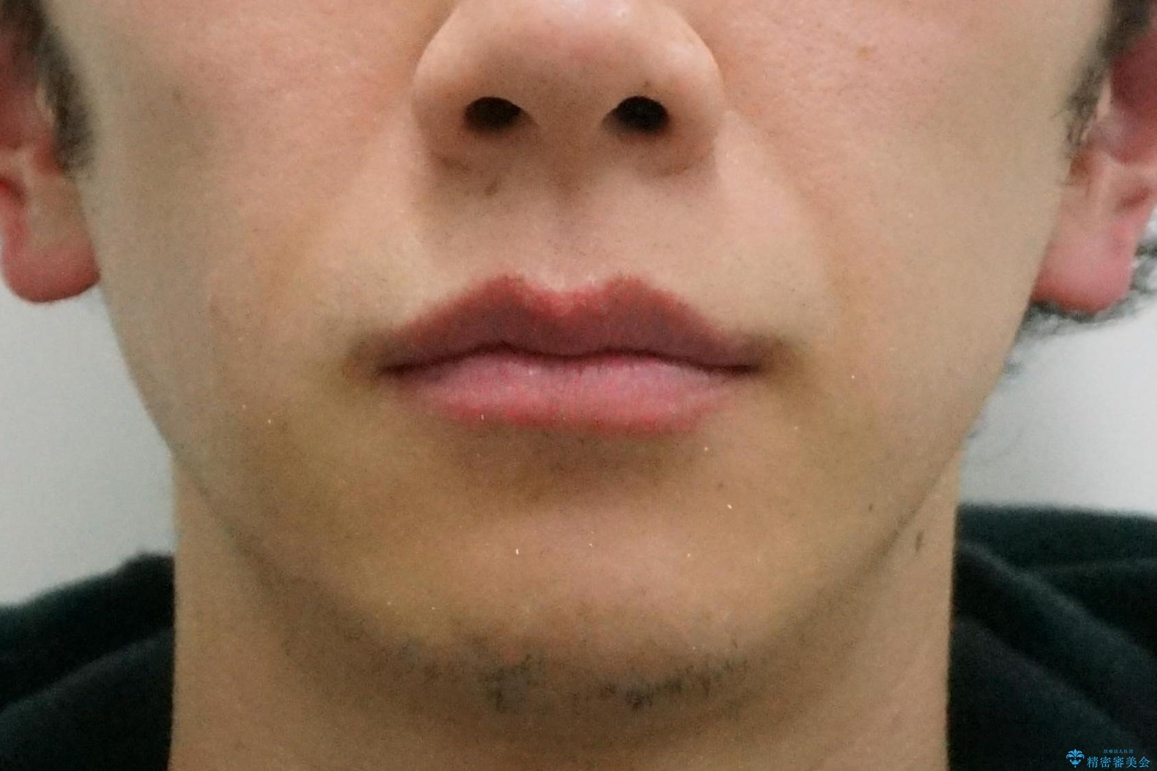 出っ歯をしっかり引っ込めたいの治療後(顔貌)