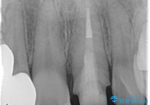 前歯を綺麗にしたい ジルコニアクラウンでの治療の治療中