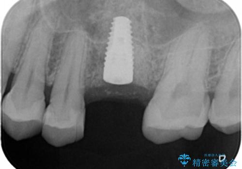 予後の悪い歯を抜歯 インプラントでの治療の治療中