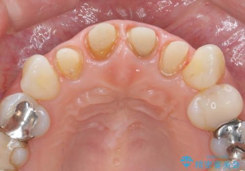 黒ずんだ見栄えの悪い前歯をきれいにしたいの治療中