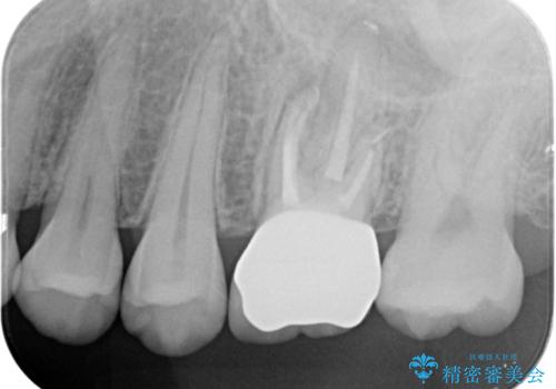 不適合な被せ物 ジルコニアクラウンでの再治療の治療後