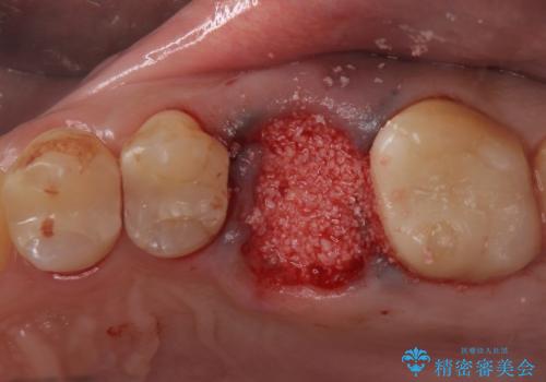 予後の悪い歯を抜歯 インプラントでの治療の治療中