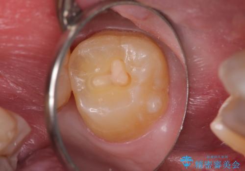 奥歯の虫歯 セラミックインレーでの修復処置の治療中