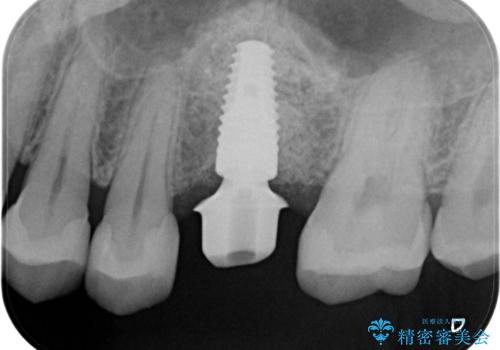 予後の悪い歯を抜歯 インプラントでの治療の治療中