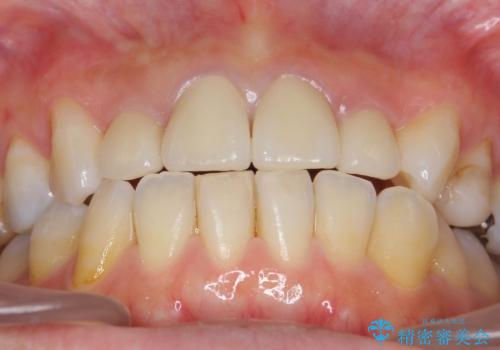 黒ずんだ見栄えの悪い前歯をきれいにしたいの治療後