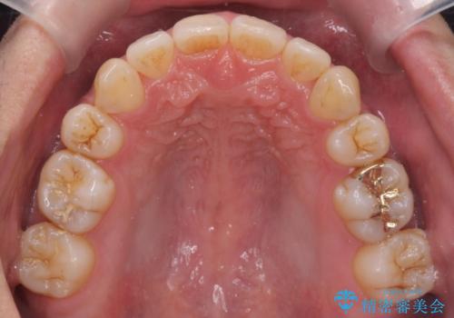 出っ歯をしっかり引っ込めたいの治療後