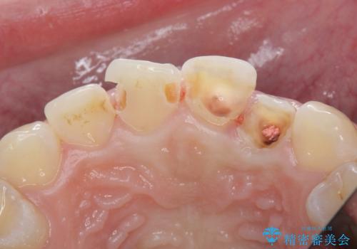 [ セラミック治療 ]  前歯の変色をきれいにしたいの治療中
