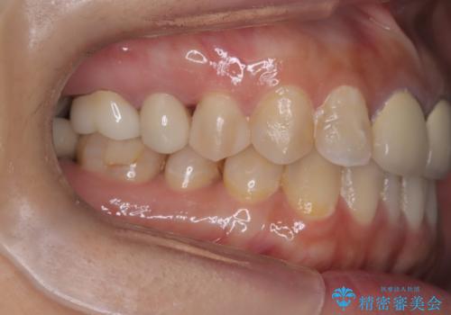 【セラミックインレー】フロスを通すと血が出て臭うの治療後