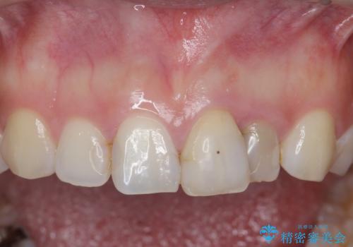 [ セラミック治療 ]  前歯の変色をきれいにしたいの治療前