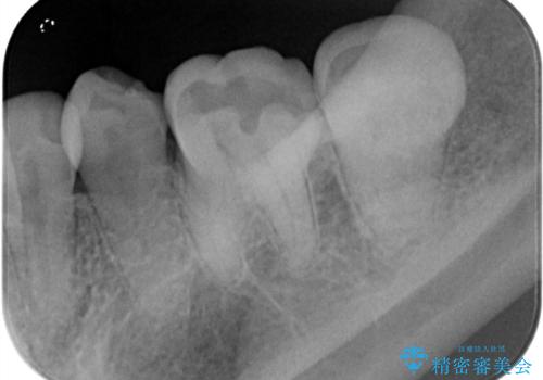 樋状根(といじょうこん)の根管治療の治療前