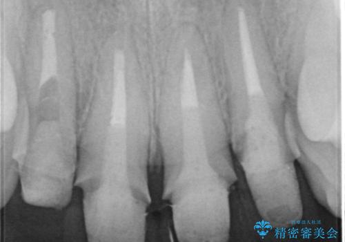 黒ずんだ見栄えの悪い前歯をきれいにしたいの治療中