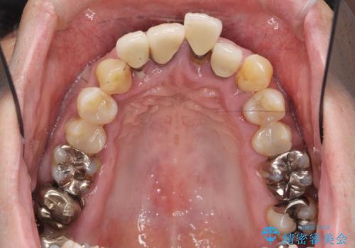 インプラント・ブリッジ補綴を含む、歯周病全顎治療の治療前