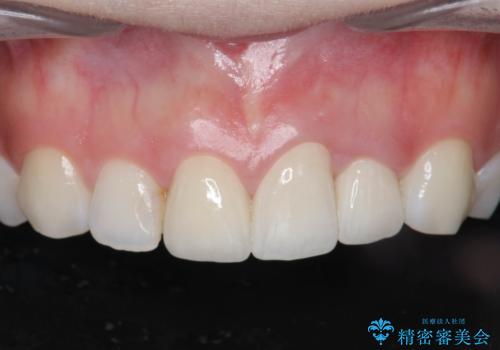 [ セラミック治療 ]  前歯の変色をきれいにしたいの症例 治療後