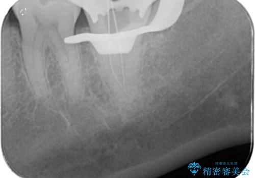 樋状根(といじょうこん)の根管治療の治療中