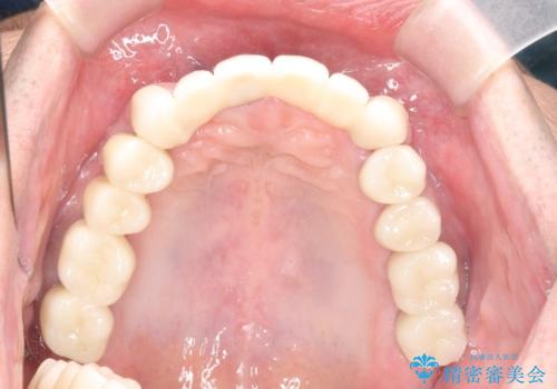 インプラント・ブリッジ補綴を含む、歯周病全顎治療の治療後