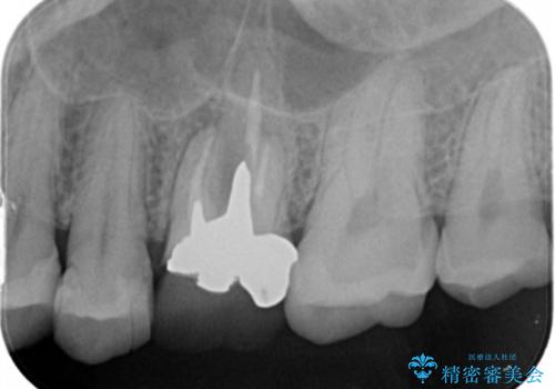 予後の悪い歯を抜歯　インプラントでの治療の治療前