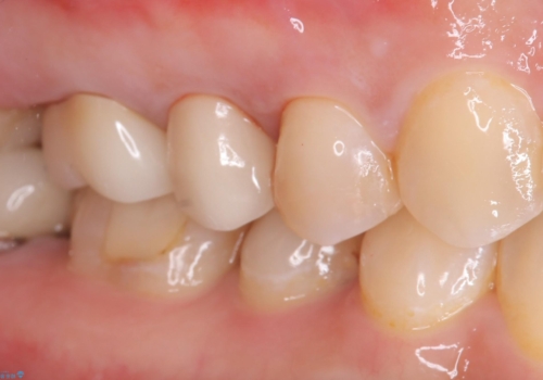 【セラミックインレー】フロスを通すと血が出て臭うの治療前
