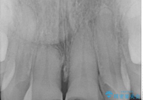 詰め物が突然とれたの治療前