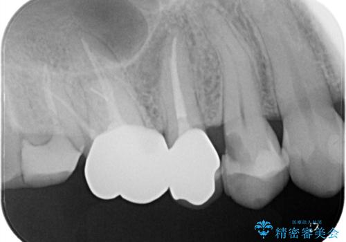【セラミックインレー】フロスを通すと血が出て臭うの治療前