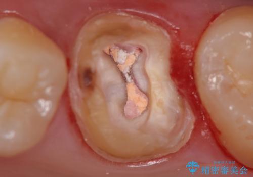 不適合な被せ物 ジルコニアクラウンでの再治療の治療中