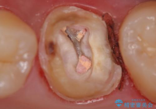 不適合な被せ物 ジルコニアクラウンでの再治療の治療後