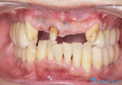 インプラント・ブリッジ補綴を含む、歯周病全顎治療の治療中