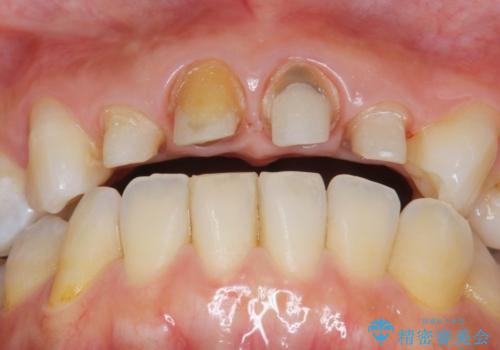 黒ずんだ見栄えの悪い前歯をきれいにしたいの治療中