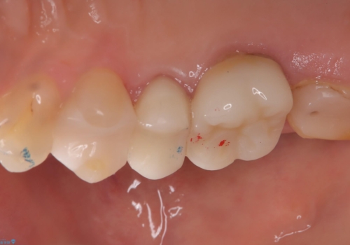 【セラミックインレー】フロスを通すと血が出て臭うの治療後