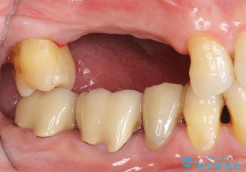 失った奥歯を、インプラント治療で機能回復の治療前