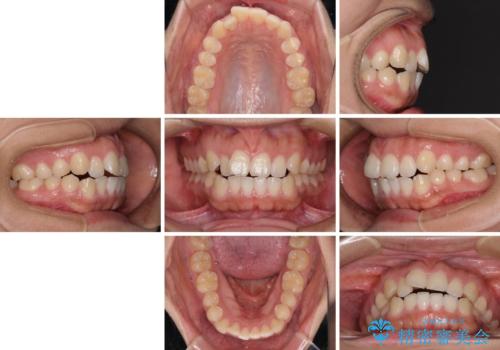 気がつくと唇が開く 口元を下げる抜歯矯正の治療前
