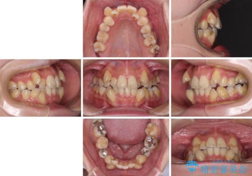 【モニター】上下の八重歯を治したい ワイヤー装置による矯正治療の治療前