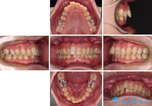 深い咬み合わせで顎が疲れる ワイヤー矯正でディープバイトを解消の治療前