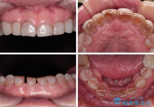 前歯の変色と隙間を治したい 前歯の審美歯科治療の治療前