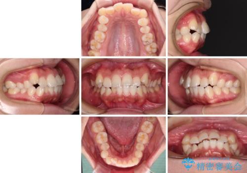 くちばしのような前歯が気になる ワイヤー装置による抜歯矯正治療の治療前