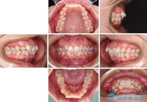 前歯のガタガタを整えたい ワイヤー装置による抜歯矯正治療の治療前