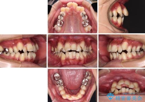 八重歯と開咬 ワイヤー装置での抜歯矯正の治療前