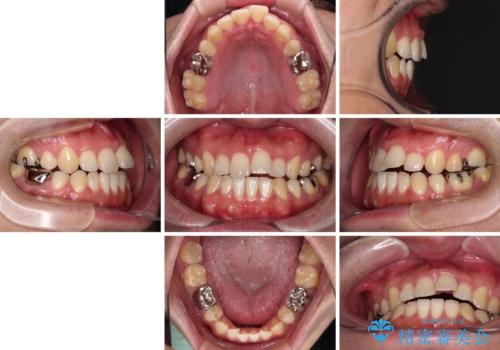 【モニター】舌のトレーニングを行いながら後戻りの再矯正の治療前