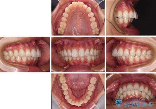 尖った前歯を引っ込めたい 目立たないワイヤー装置での抜歯矯正の治療前